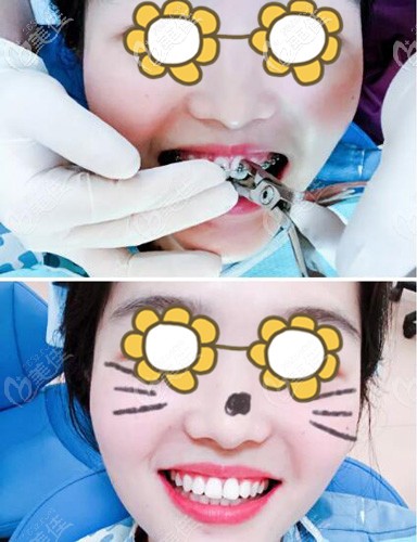 去掉金屬托槽后的牙齒整齊自然 去掉金屬托槽后的牙齒整齊自然