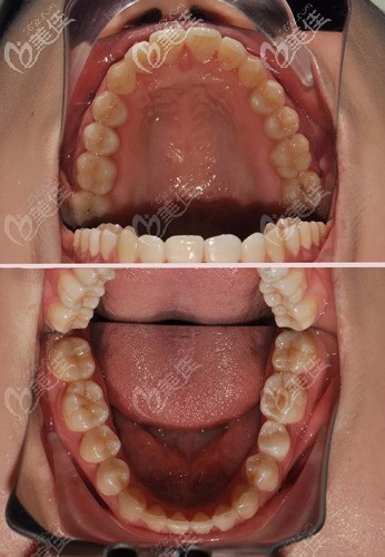 合肥美奧口腔小護士自述：就戴了快一年的金屬托槽，牙齒不齊就給矯正過來啦