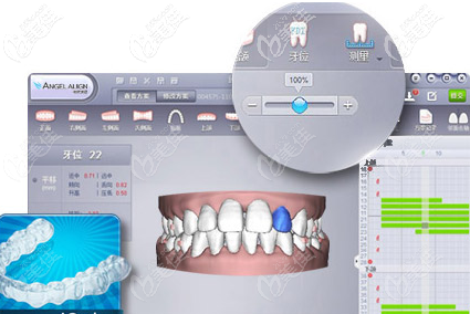 德國(guó)正畸軟件模擬影像
