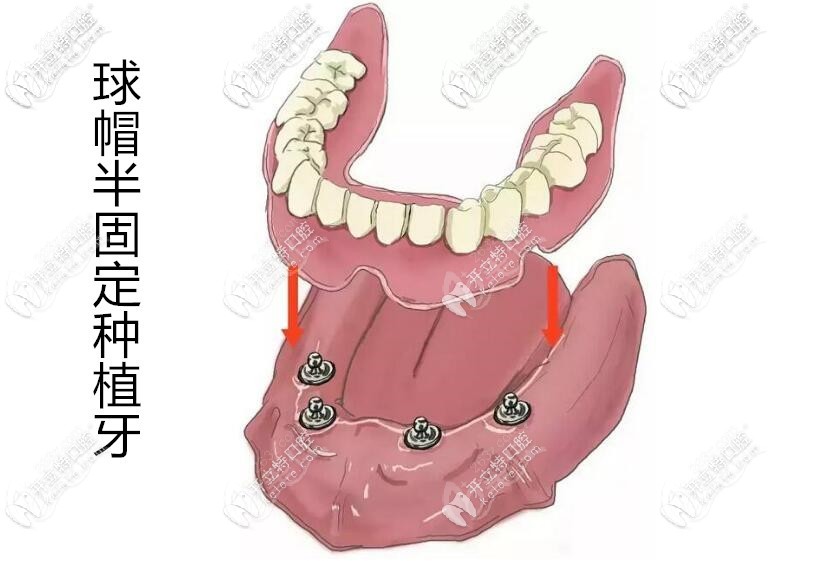 全口半固定種植牙