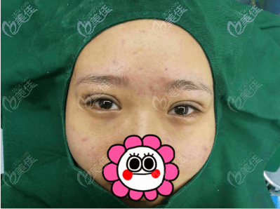 做完埋線(xiàn)雙眼皮手術(shù)即刻照 做完埋線(xiàn)雙眼皮手術(shù)即刻照