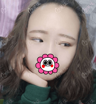 北京如朵埋線(xiàn)雙眼皮 北京如朵埋線(xiàn)雙眼皮