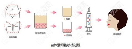 余院長做自體脂肪面部填充原理 余院長做自體脂肪面部填充原理