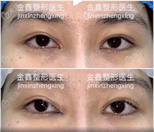 金鑫內(nèi)眼角修復(fù)回包案例 金鑫內(nèi)眼角修復(fù)回包案例