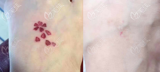 激光洗紅色紋身的效果圖 激光洗紅色紋身的效果圖