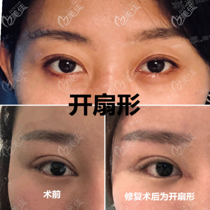 雙眼皮外折平行改內(nèi)折圖片