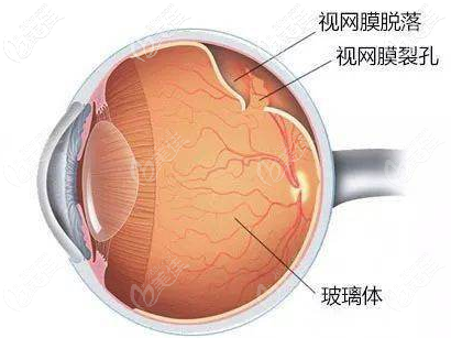 激光導致視網(wǎng)膜脫落