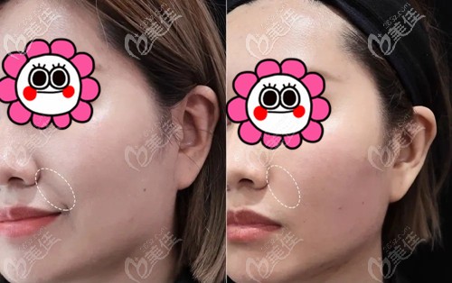 廈門臉博士喬雅登玻尿酸注射法令紋