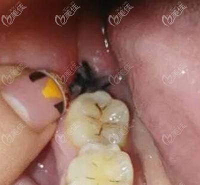 拔牙后得了干槽癥的牙窩 拔牙后得了干槽癥的牙窩