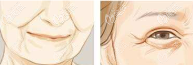 面部松弛下垂等示意圖 面部松弛下垂等示意圖
