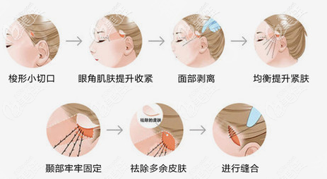 SMAS面部提升手術(shù)過(guò)程示意圖 SMAS面部提升手術(shù)過(guò)程示意圖