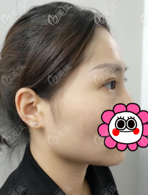 還記得在北京俏中關做定點雙眼皮,恢復到一個多月時就比較自然了