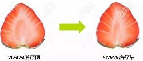 美國薇蜜viveve縮陰的效果