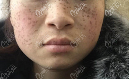 C6祛斑結(jié)痂后的樣子
