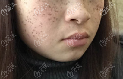 C6祛斑第10天的樣子