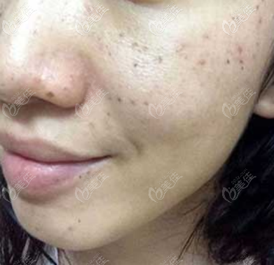 色素沉著加上反黑的樣子