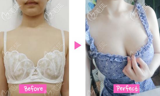 鄭在皓魔滴假體隆胸<span style= 鄭在皓魔滴假體隆胸<span style=