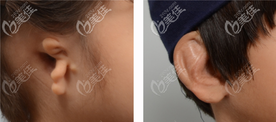 先天性小耳畸形矯正圖 先天性小耳畸形矯正圖