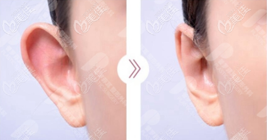 韓國普羅菲耳醫(yī)院招風(fēng)耳整形<span style= 韓國普羅菲耳醫(yī)院招風(fēng)耳整形<span style=