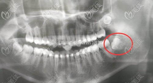 拔智齒前的阻生智齒 拔智齒前的阻生智齒