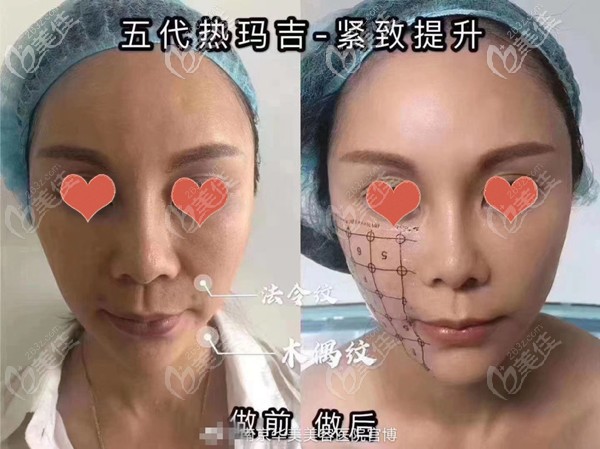 四代五代熱瑪吉都有的南京華美，看過熱瑪吉對比效果圖，才做的全面部600發(fā)抗衰