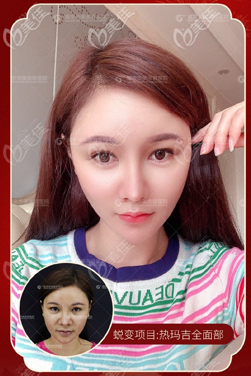 在南京華美做全臉熱瑪吉600發(fā)術(shù)前術(shù)后對(duì)比