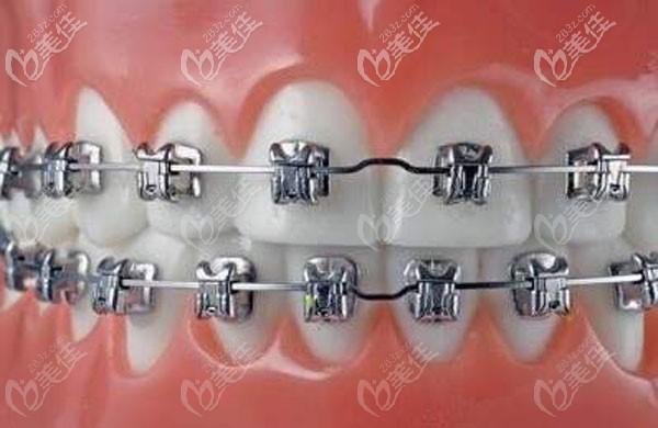 傳統(tǒng)金屬牙齒矯正