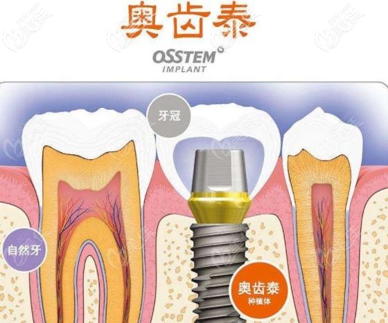 奧齒泰種植體 奧齒泰種植體