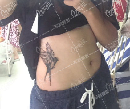 重慶軍科水動力腰腹吸脂恢復(fù)過程圖，一點(diǎn)不疼是假的