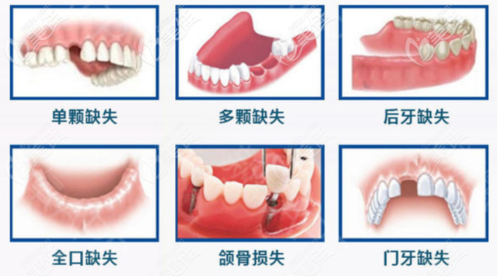 杭州臨平城南口腔醫(yī)院種植牙介紹