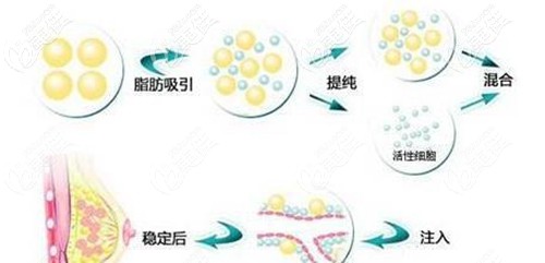 自體脂肪豐胸的過(guò)程