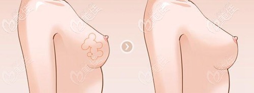自體脂肪豐胸