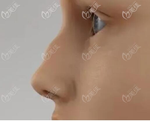 波浪鼻其實算是駝峰鼻的一種 波浪鼻其實算是駝峰鼻的一種