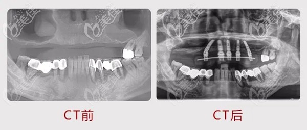 張先生在麥芽口腔做上半口種植牙CT 張先生在麥芽口腔做上半口種植牙CT