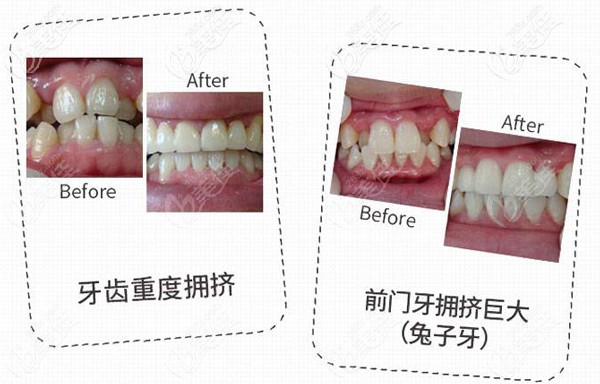 趙丹醫(yī)生隱形牙齒矯正案例