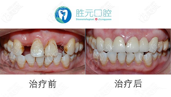 看看勝元口腔做種植牙怎么樣