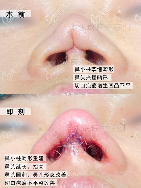 自體肋軟骨修復(fù)鼻失敗案例