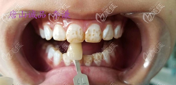 術(shù)前牙齒發(fā)黃崩損