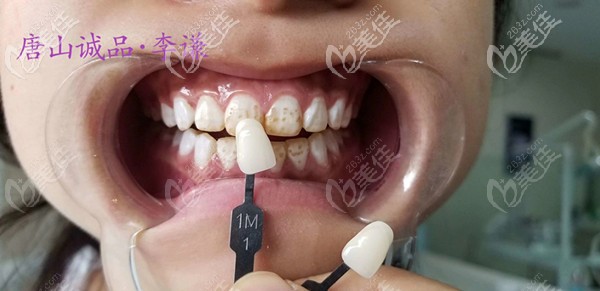 唐山誠(chéng)品口腔簡(jiǎn)美瓷貼面