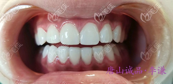 唐山誠(chéng)品口腔簡(jiǎn)美超薄瓷貼面修復(fù)案例