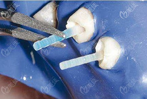 纖維樁是可以取出的