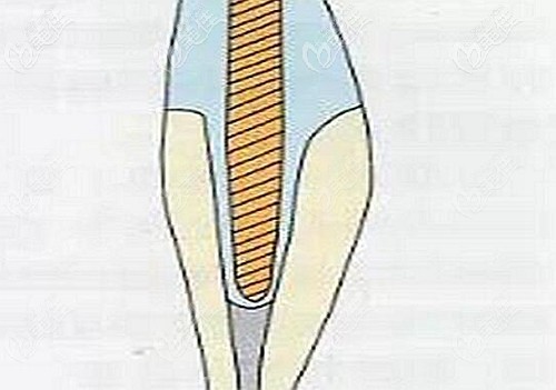 纖維樁的孔隙圖