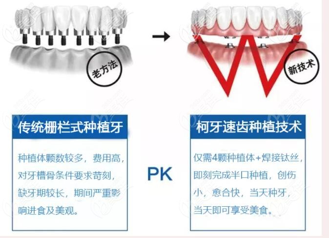 傳統(tǒng)種植牙和速齒技術(shù)區(qū)別