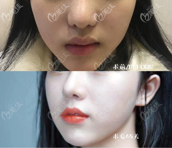 海鷗唇整形前后效果對比