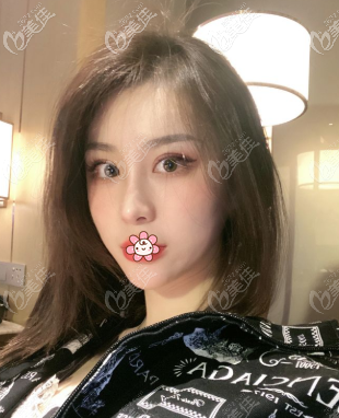 陳健醫(yī)生給我做完肋骨鼻一個(gè)月 陳健醫(yī)生給我做完肋骨鼻一個(gè)月