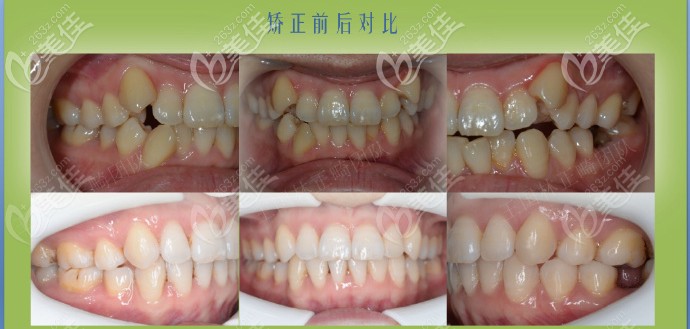 王國林隱形矯正案例