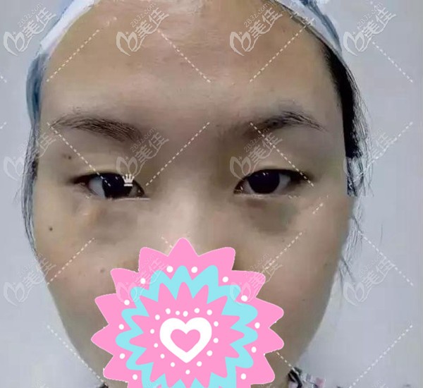 韓美全切雙眼皮之前 韓美全切雙眼皮之前