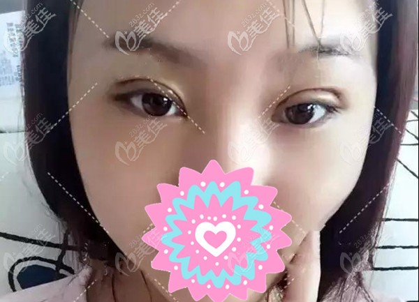 潮州韓美全切雙眼皮案例 潮州韓美全切雙眼皮案例