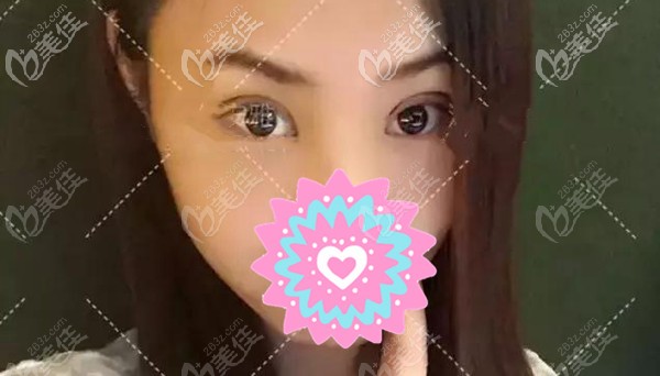 韓美整形醫(yī)院眼部整形案例 韓美整形醫(yī)院眼部整形案例