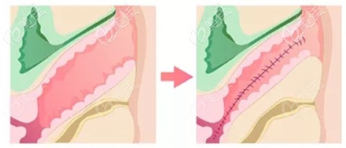 陰道緊縮手術(shù) 陰道緊縮手術(shù)